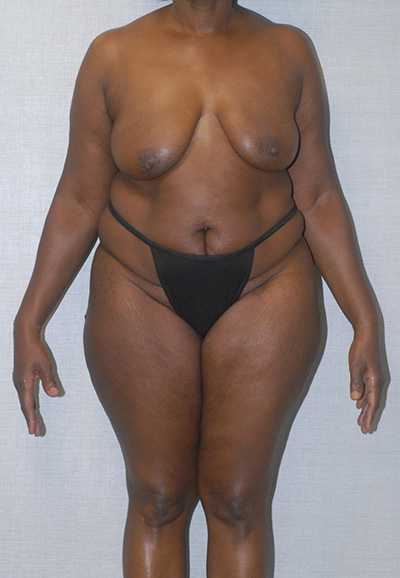Liposuction Before & After Image
