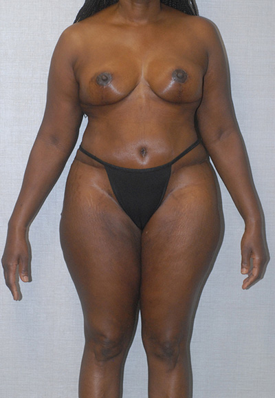 Liposuction Before & After Image