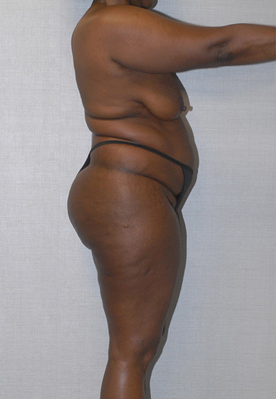 Liposuction Before & After Image