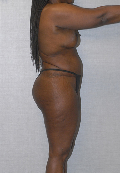 Liposuction Before & After Image