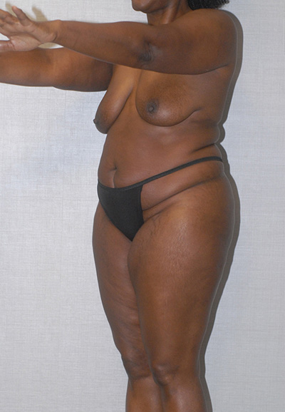 Liposuction Before & After Image