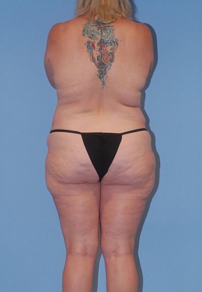 Liposuction Before & After Image