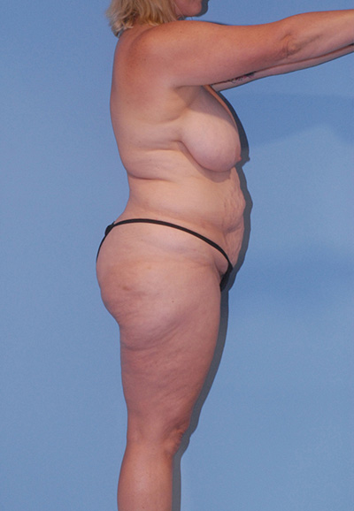 Liposuction Before & After Image