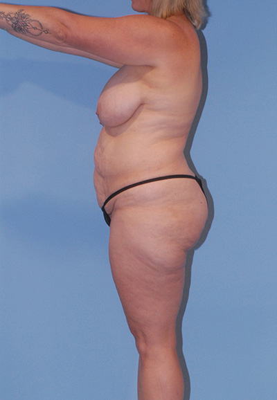 Liposuction Before & After Image