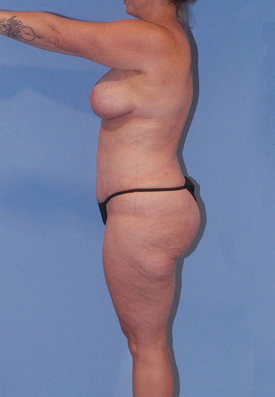 Liposuction Before & After Image