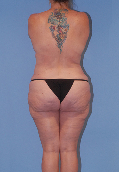 Liposuction Before & After Image