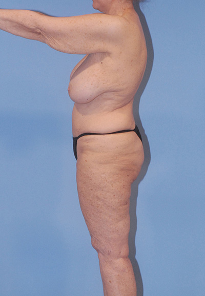 Liposuction Before & After Image