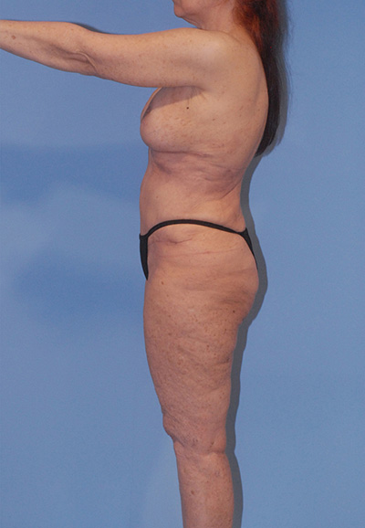 Liposuction Before & After Image