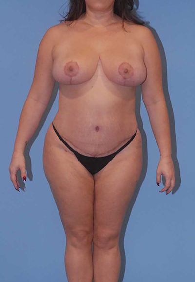 Liposuction Before & After Image