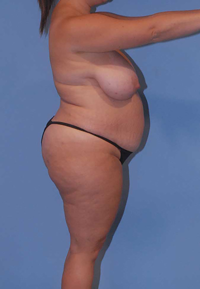 Liposuction Before & After Image
