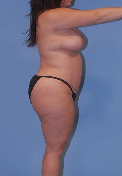 Liposuction Before & After Image