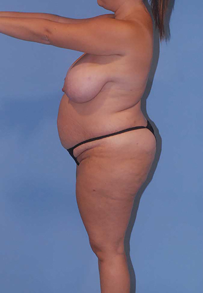 Liposuction Before & After Image