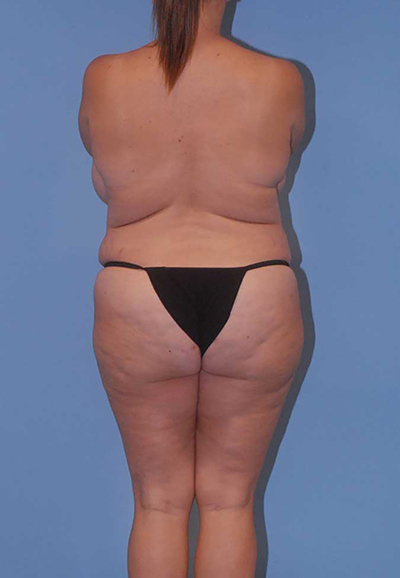 Liposuction Before & After Image