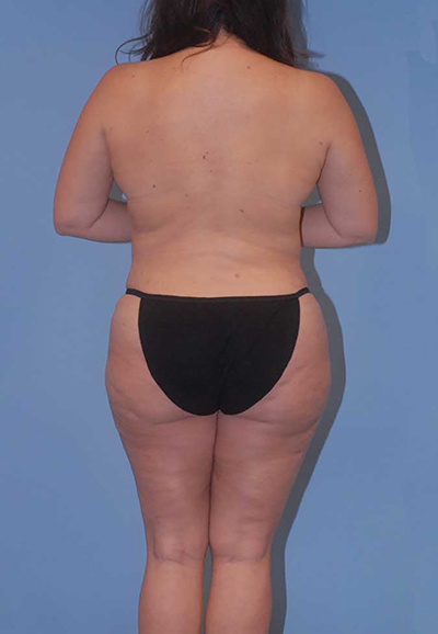 Liposuction Before & After Image