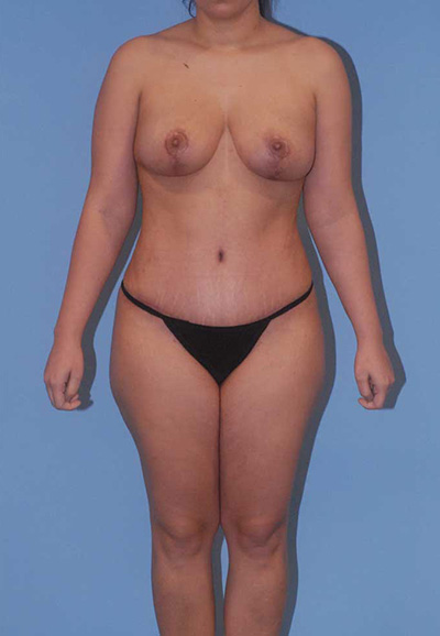 Liposuction Before & After Image