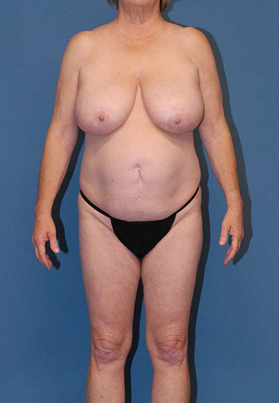 Liposuction Before & After Image