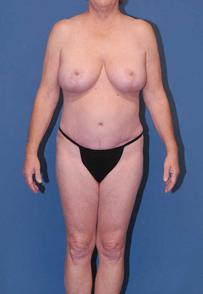 Liposuction Before & After Image