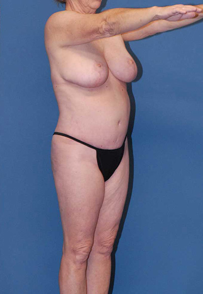 Liposuction Before & After Image
