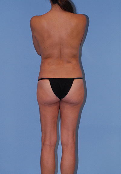 Liposuction Before & After Image