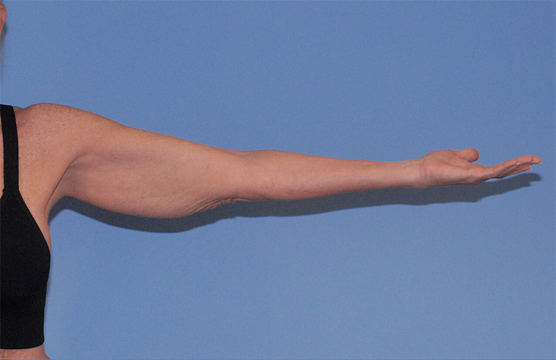 Liposuction Before & After Image
