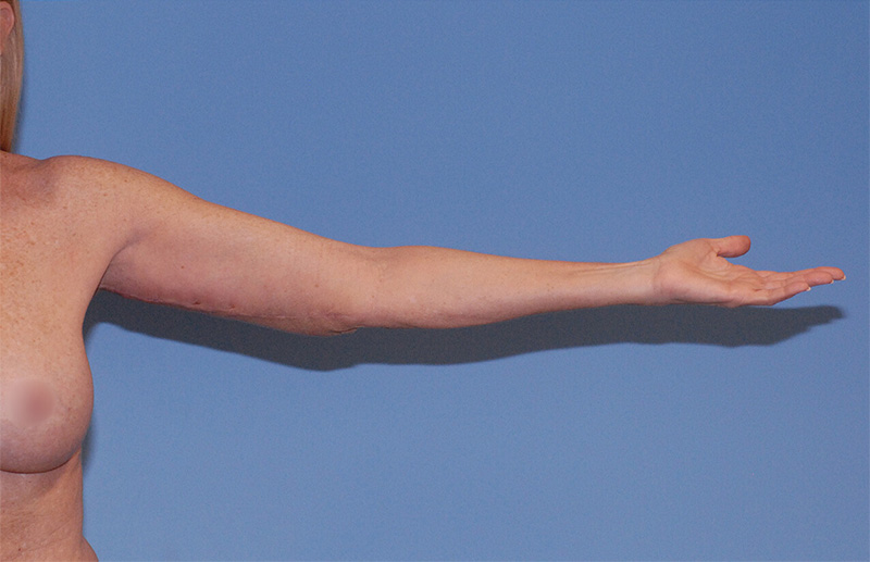 Liposuction Before & After Image