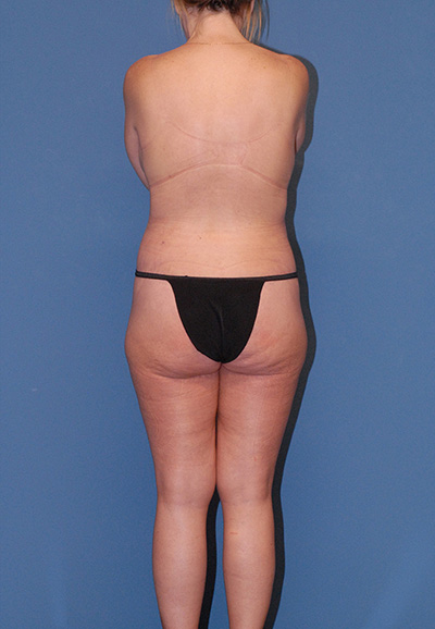 Liposuction Before & After Image