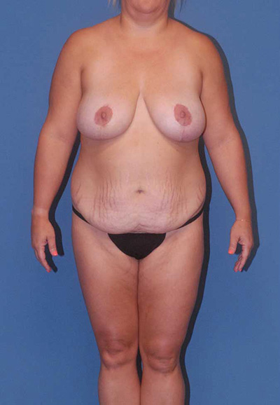 Liposuction Before & After Image