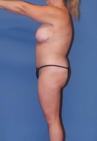 Liposuction Before & After Image
