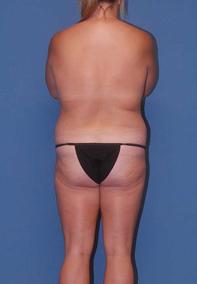 Liposuction Before & After Image