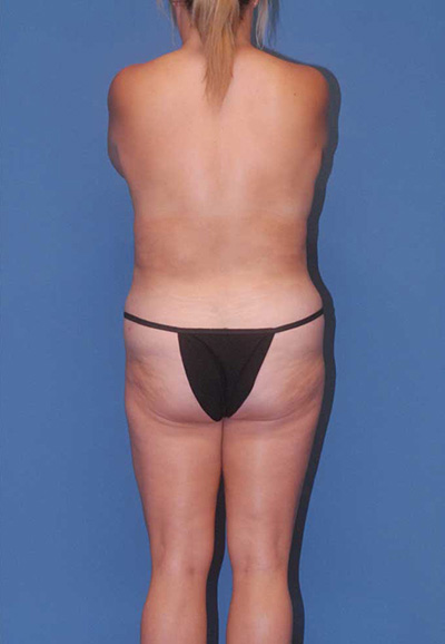 Liposuction Before & After Image