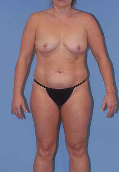 Liposuction Before & After Image