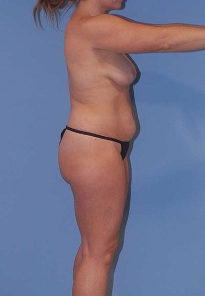 Liposuction Before & After Image