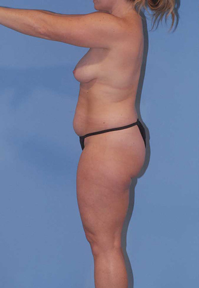 Liposuction Before & After Image