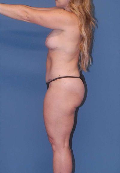 Liposuction Before & After Image