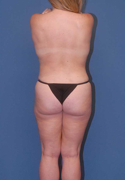 Liposuction Before & After Image