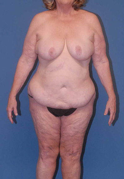Liposuction Before & After Image