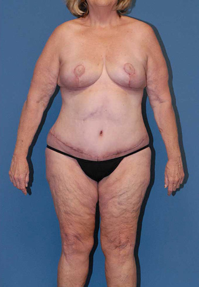 Liposuction Before & After Image