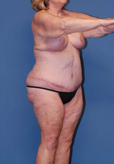 Liposuction Before & After Image
