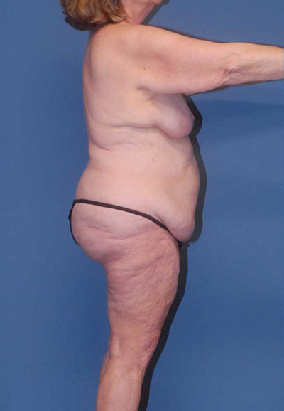 Liposuction Before & After Image