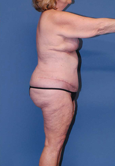 Liposuction Before & After Image