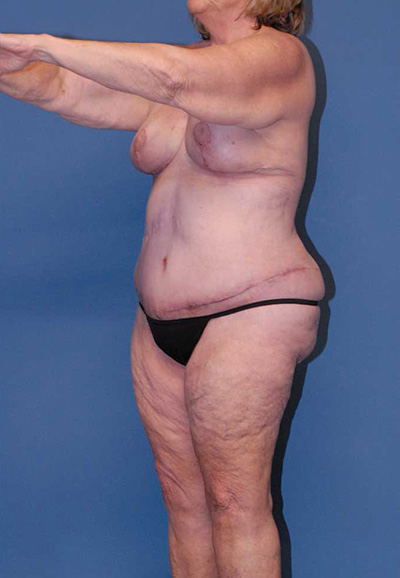 Liposuction Before & After Image