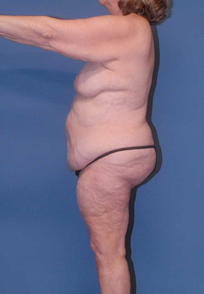 Liposuction Before & After Image