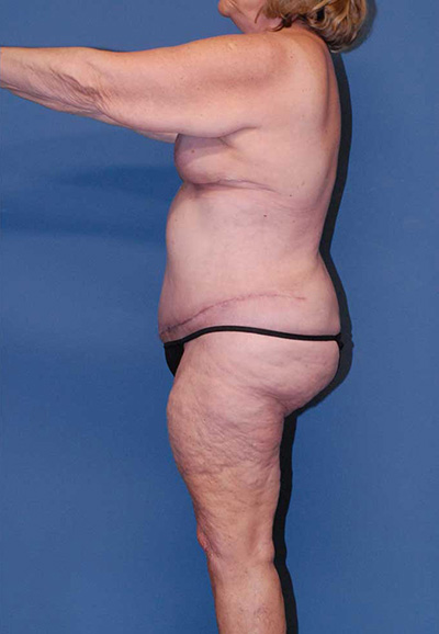 Liposuction Before & After Image