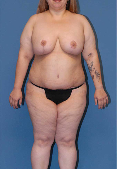 Liposuction Before & After Image