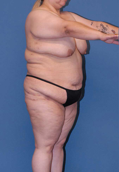 Liposuction Before & After Image