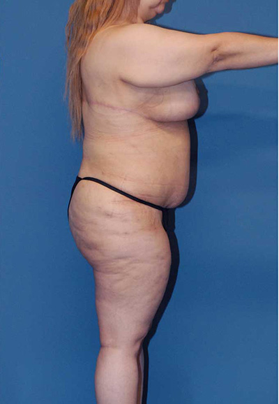 Liposuction Before & After Image