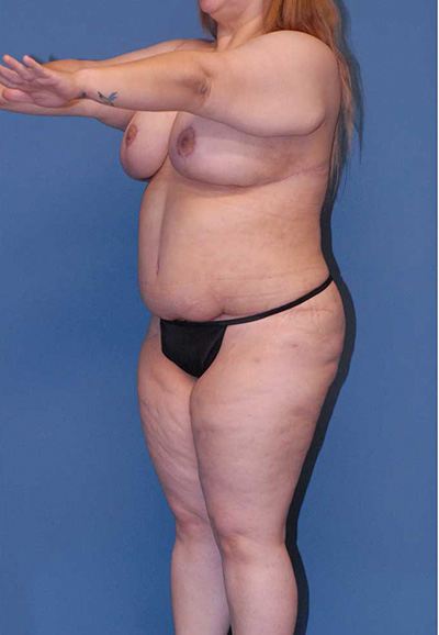 Liposuction Before & After Image