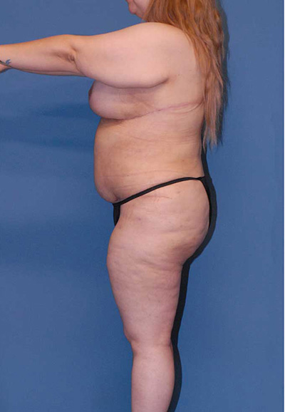 Liposuction Before & After Image