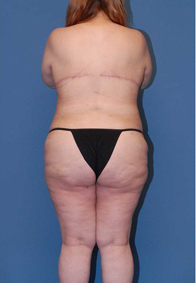 Liposuction Before & After Image