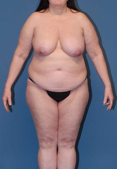 Liposuction Before & After Image